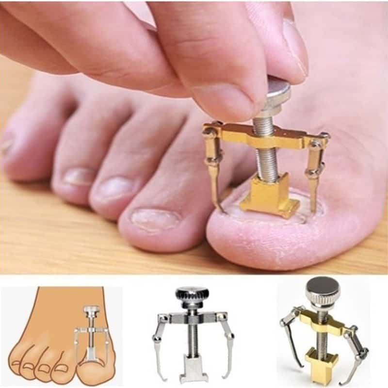 Top 10 Best Ingrown Toenail Correction Tool Must Have 1 f2413065 8a10 42d5 9ae3 7e72f547e047user 15290