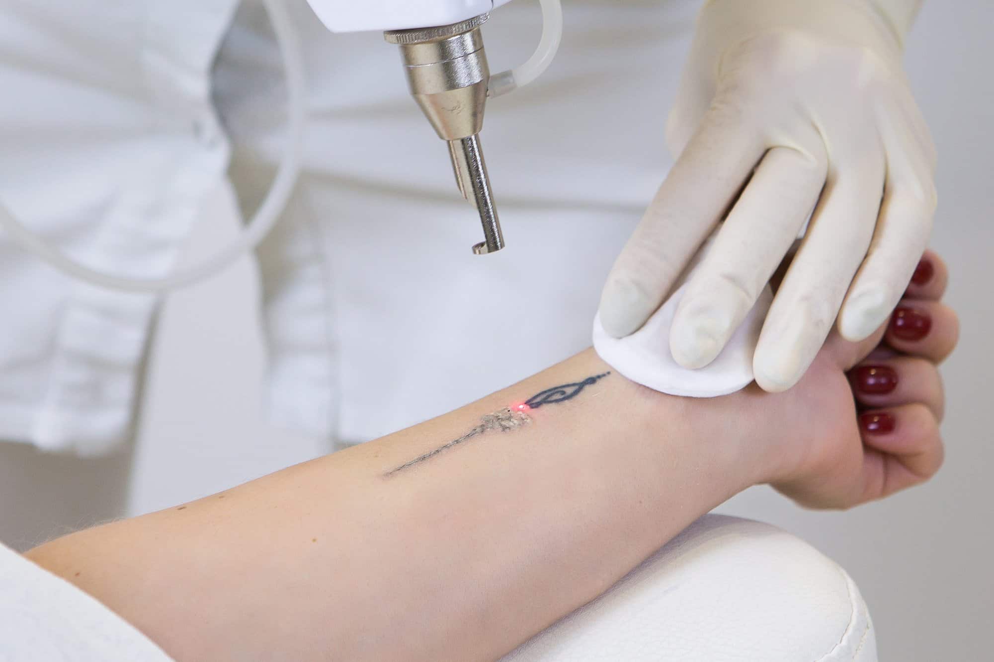laser tattoo removal laser tattoo removal 8